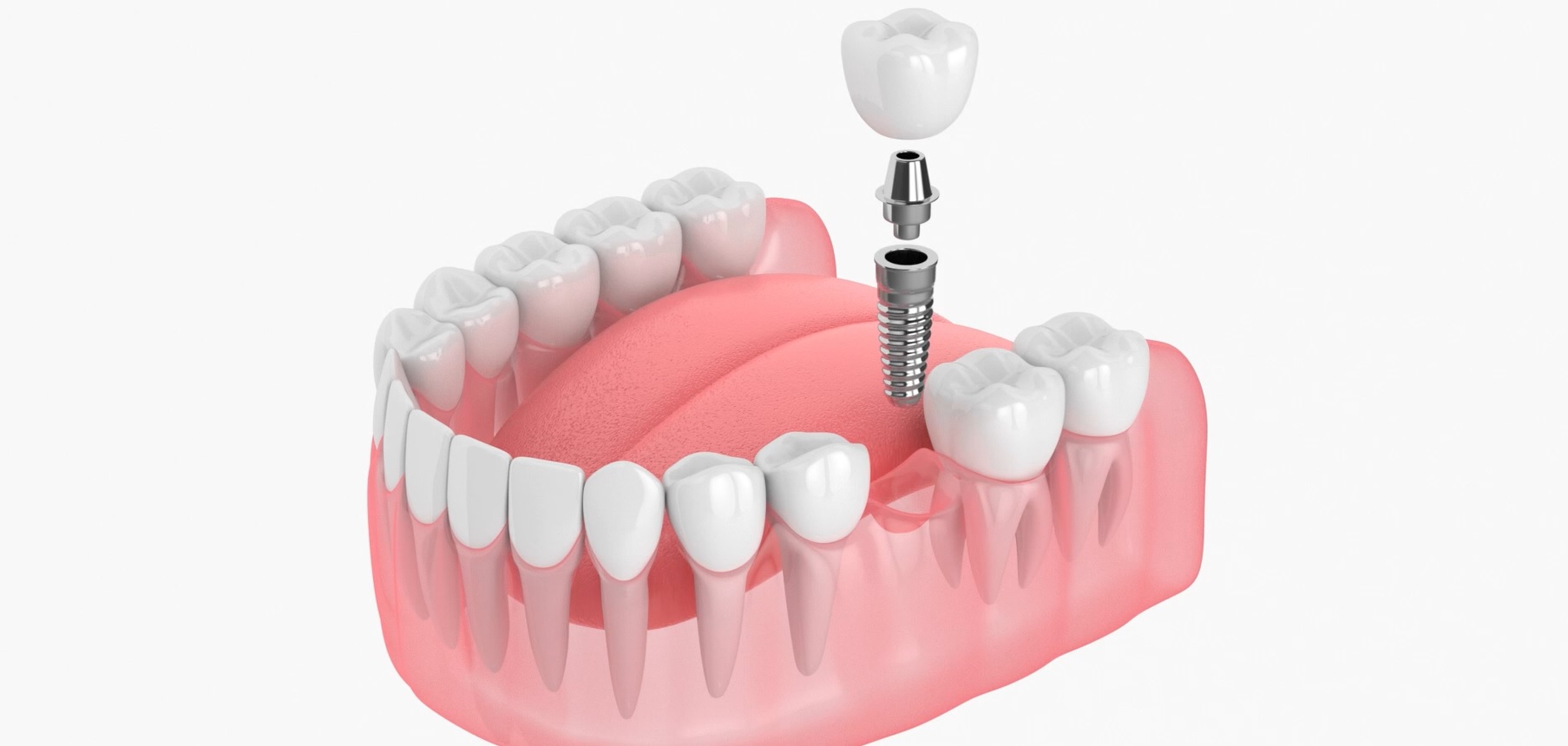 3D visual of a dental implant.